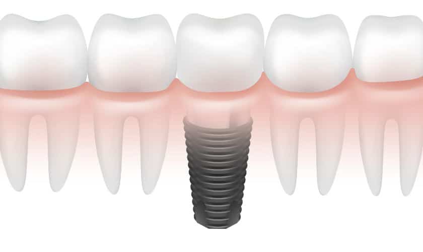 Dental Implants in Culver City, CA