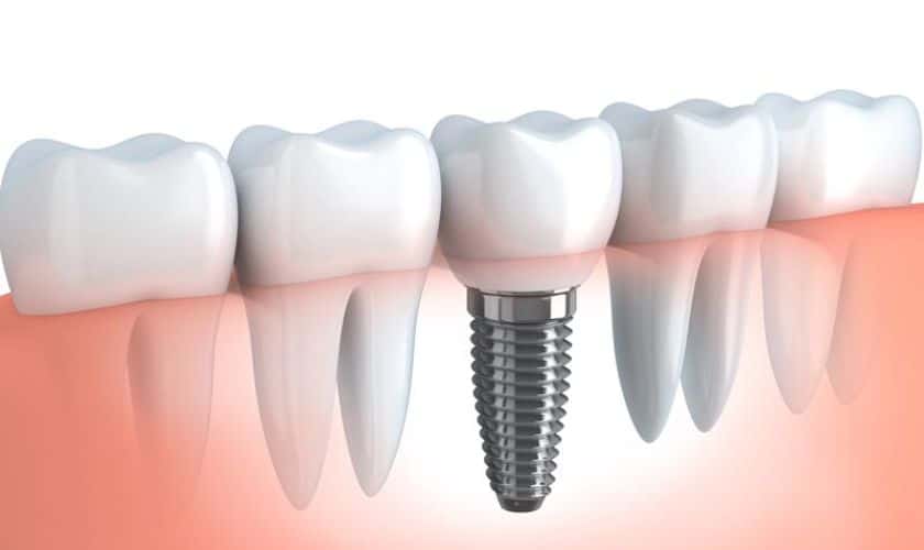 How Should I Maintain My Dental Implants