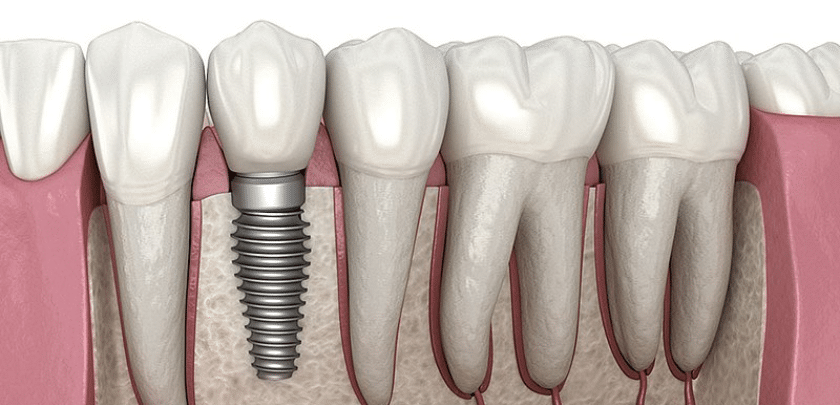 What Are The 3 Stages Of Dental Implant?