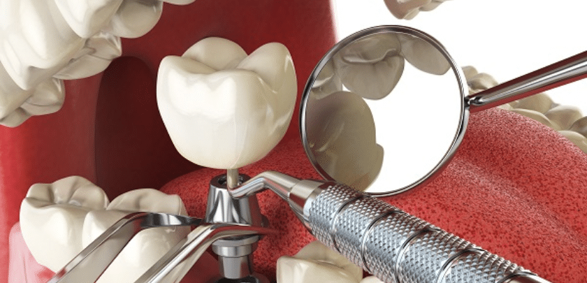 Why do dental implants break? How can it be prevented?