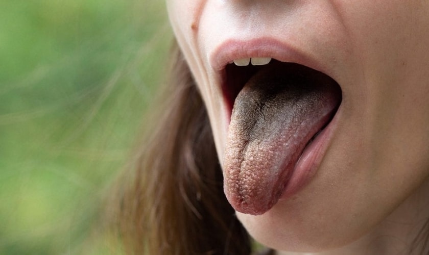 Pepto Bismol Black Tongue The Cause and How to Fix it