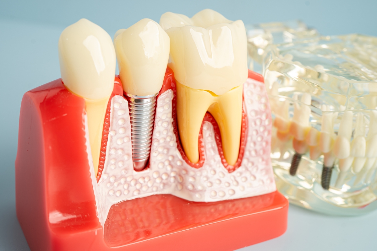 Dental Implant El Segundo